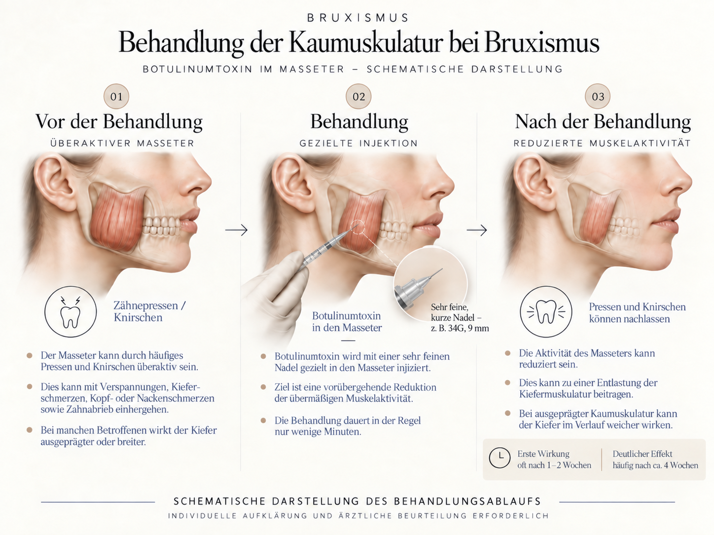 Behandlung der Kaumuskulatur mit Botulinumtoxin bei Bruxismus
